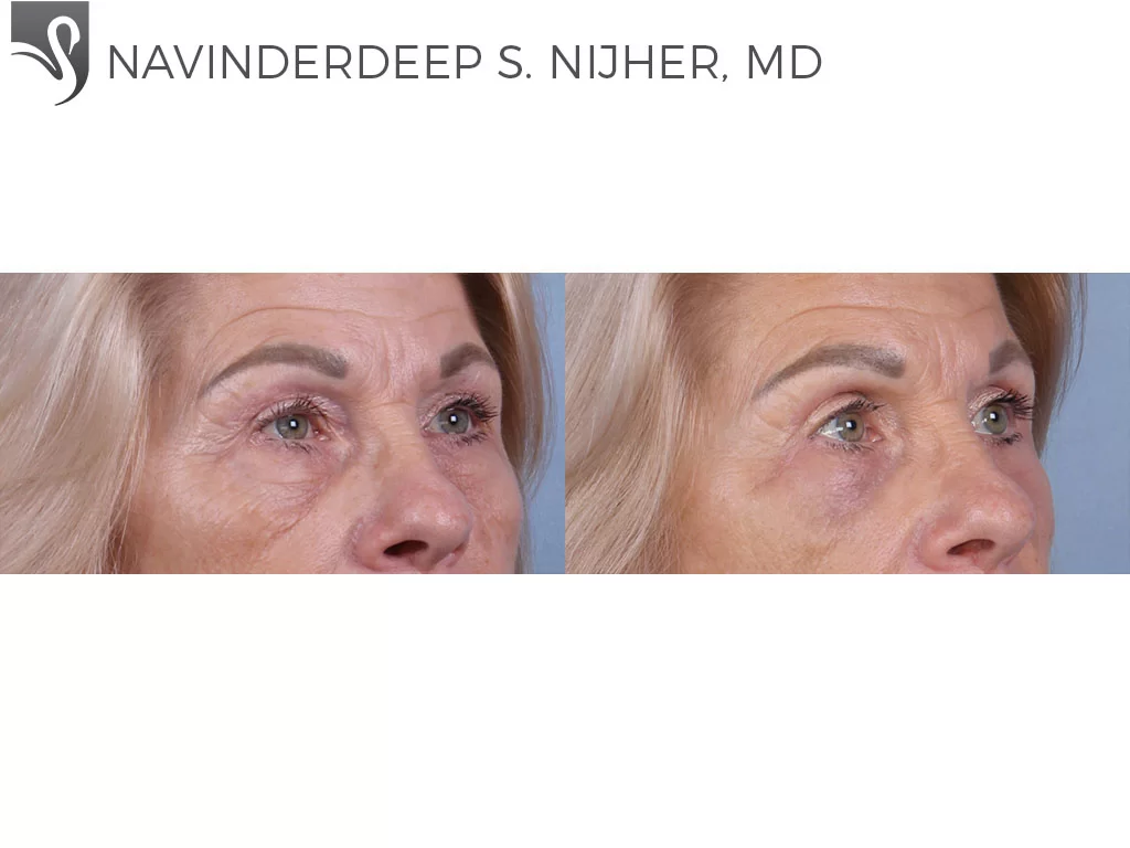 Before and After Image: Eyelid Surgery Case #76958 - right-front-oblique