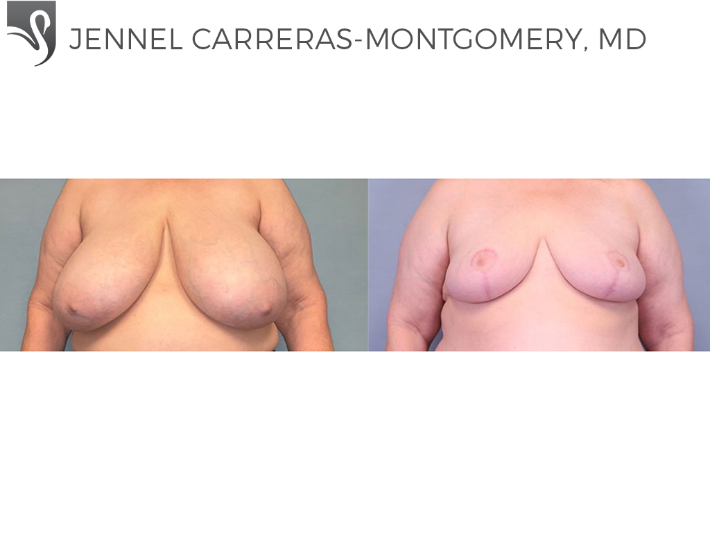 Before and After Image: Female Breast Reduction Case #76969