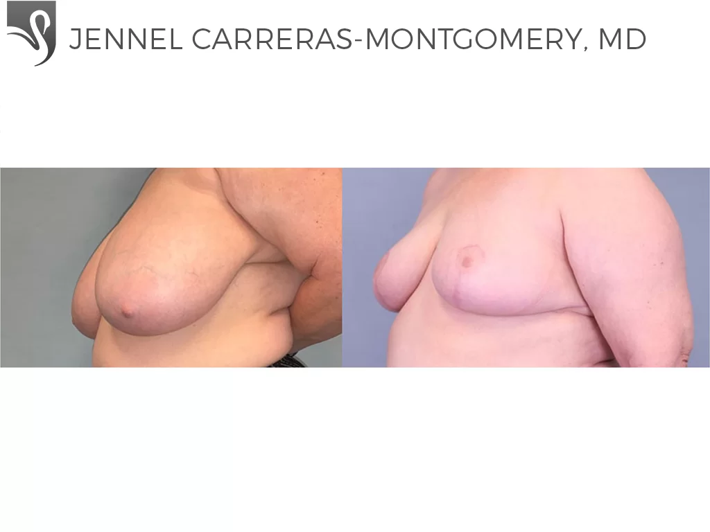 Before and After Image: Female Breast Reduction Case #76969 - left-front-oblique