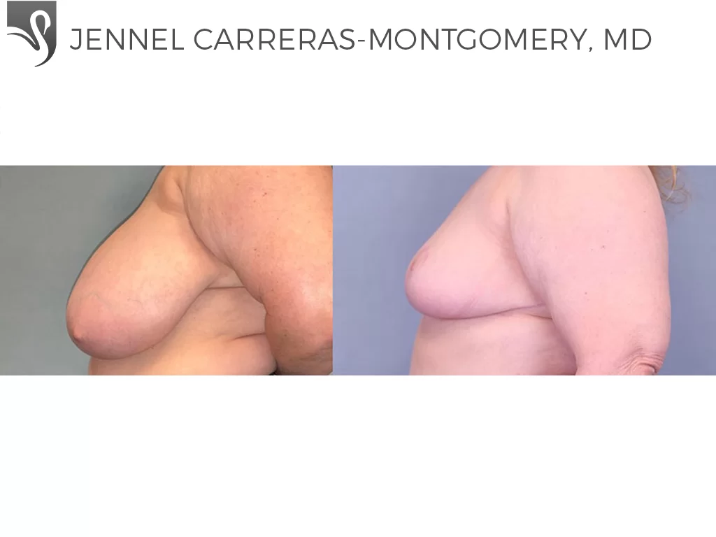 Before and After Image: Female Breast Reduction Case #76969 - left-side