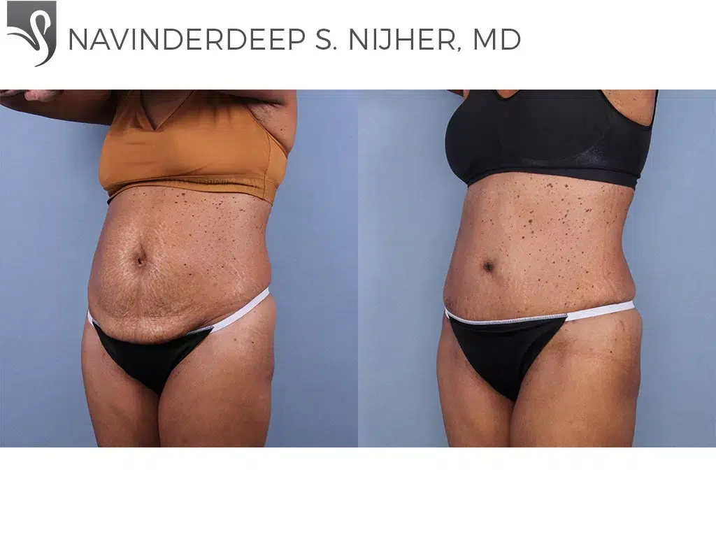 Before and After Image: Abdominoplasty (Tummy Tuck) Case #77016 - left-front-oblique