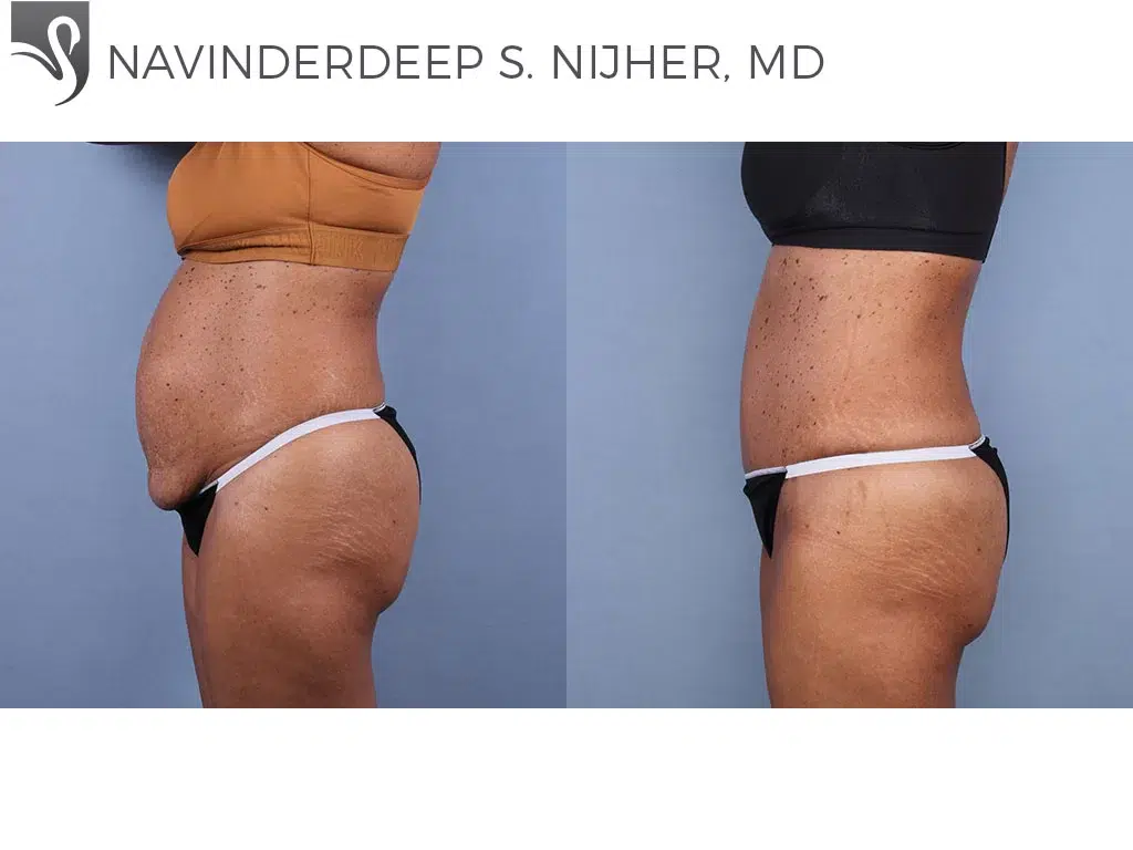 Before and After Image: Abdominoplasty (Tummy Tuck) Case #77016 - left-side