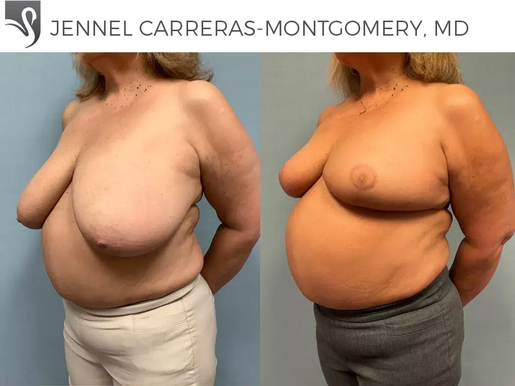 Before and After Image: Female Breast Reduction Case #77047 - left-front-oblique