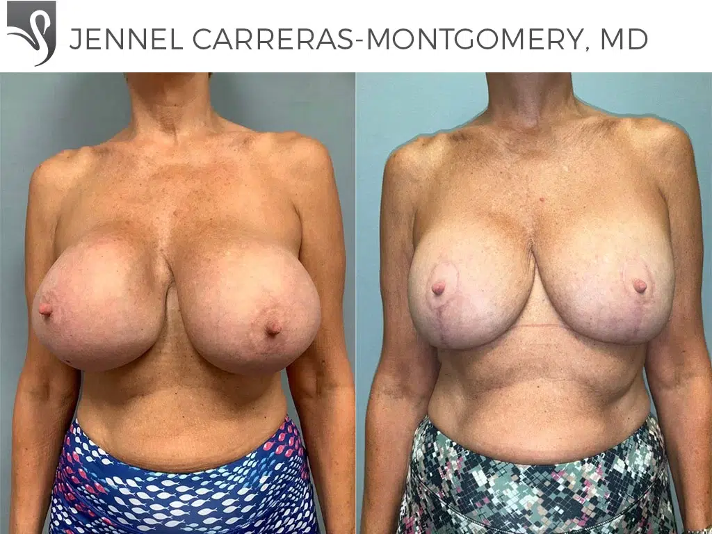 Before and After Image: Breast Lift (Mastopexy) Case #77092