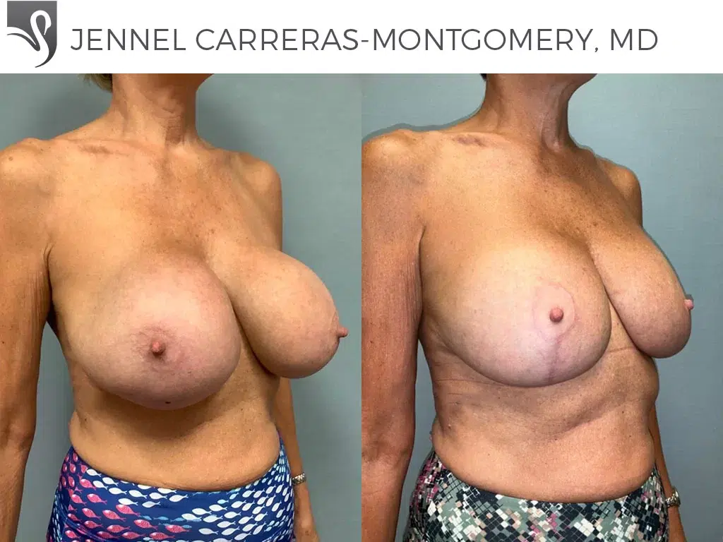 Before and After Image: Breast Lift (Mastopexy) Case #77092 - right-front-oblique