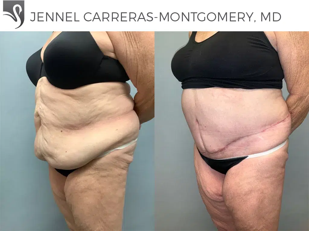 Before and After Image: Post-Bariatric Surgery Case #77099 - left-front-oblique