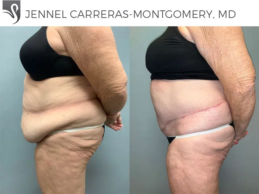 Before and After Image: Post-Bariatric Surgery Case #77099 - left-side