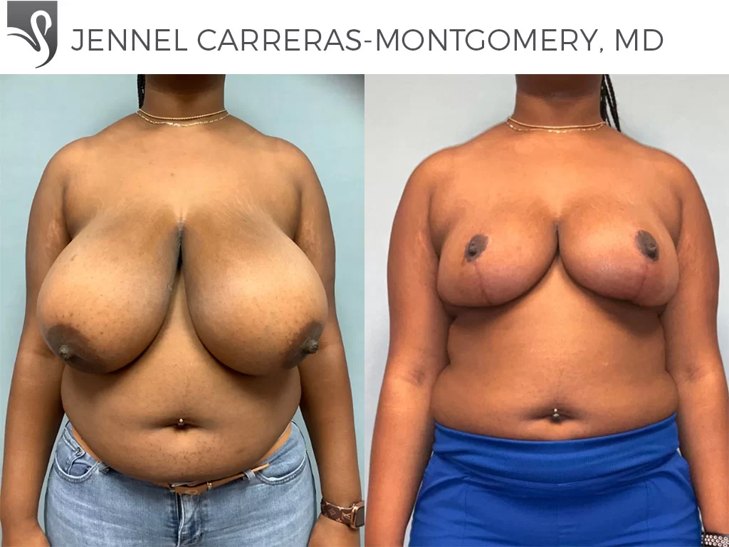 Before and After Image: Female Breast Reduction Case #77153 - front
