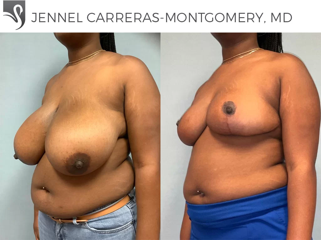 Before and After Image: Female Breast Reduction Case #77153 - left-front-oblique