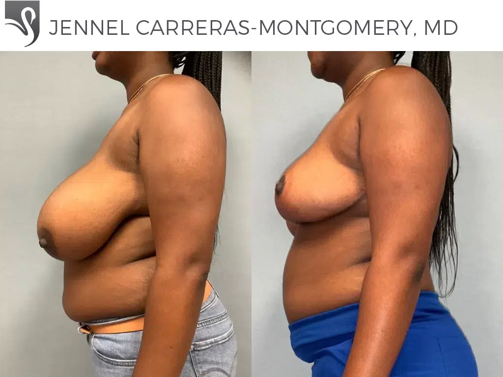 Before and After Image: Female Breast Reduction Case #77153 - left-side
