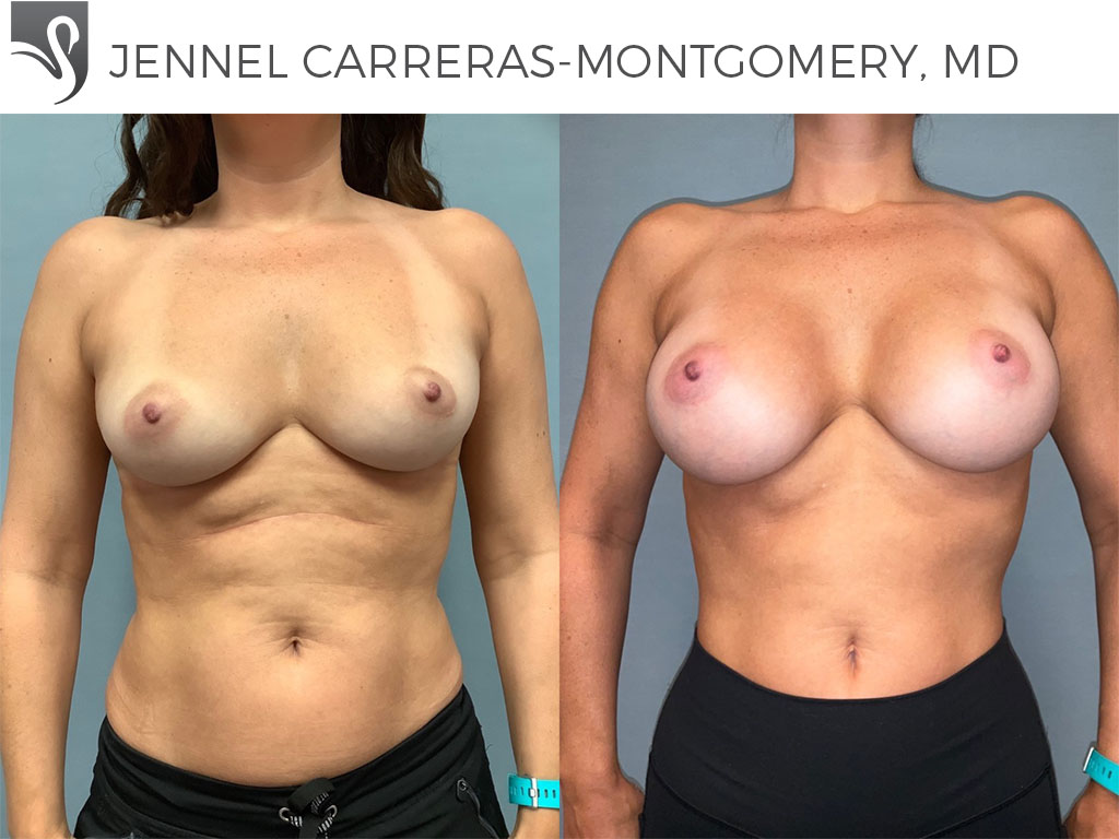 Before and After Image: Breast Augmentation Case #77318