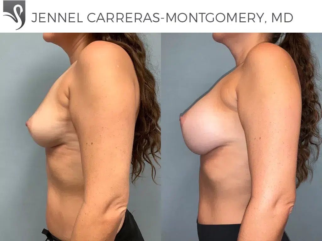 Before and After Image: Breast Augmentation Case #77318 - left-side
