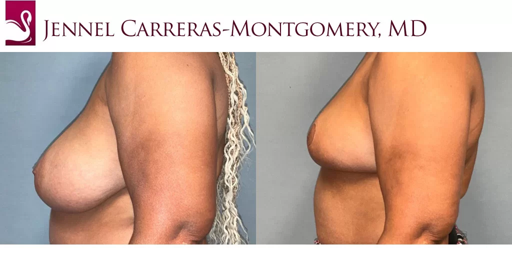 Before and After Image: Female Breast Reduction Case #77574 - left-side