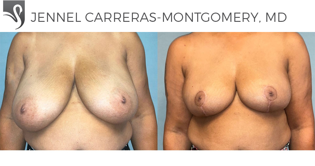 Before and After Image: Female Breast Reduction Case #77574 - front