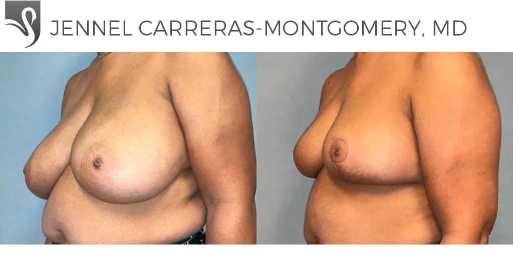 Before and After Image: Female Breast Reduction Case #77574 - left-front-oblique