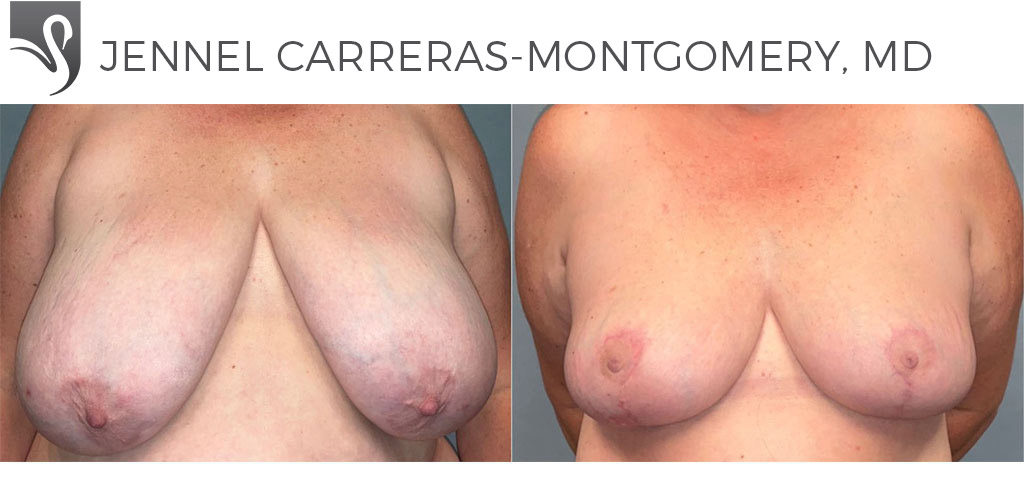 Before and After Image: Female Breast Reduction Case #77722