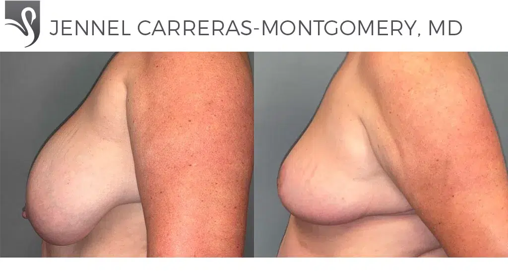 Before and After Image: Female Breast Reduction Case #77722 - left-side