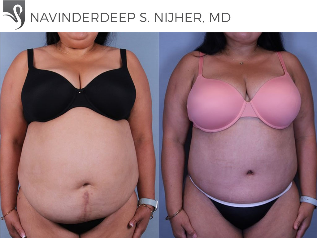 Before and After Image: Abdominoplasty (Tummy Tuck) Case #77865
