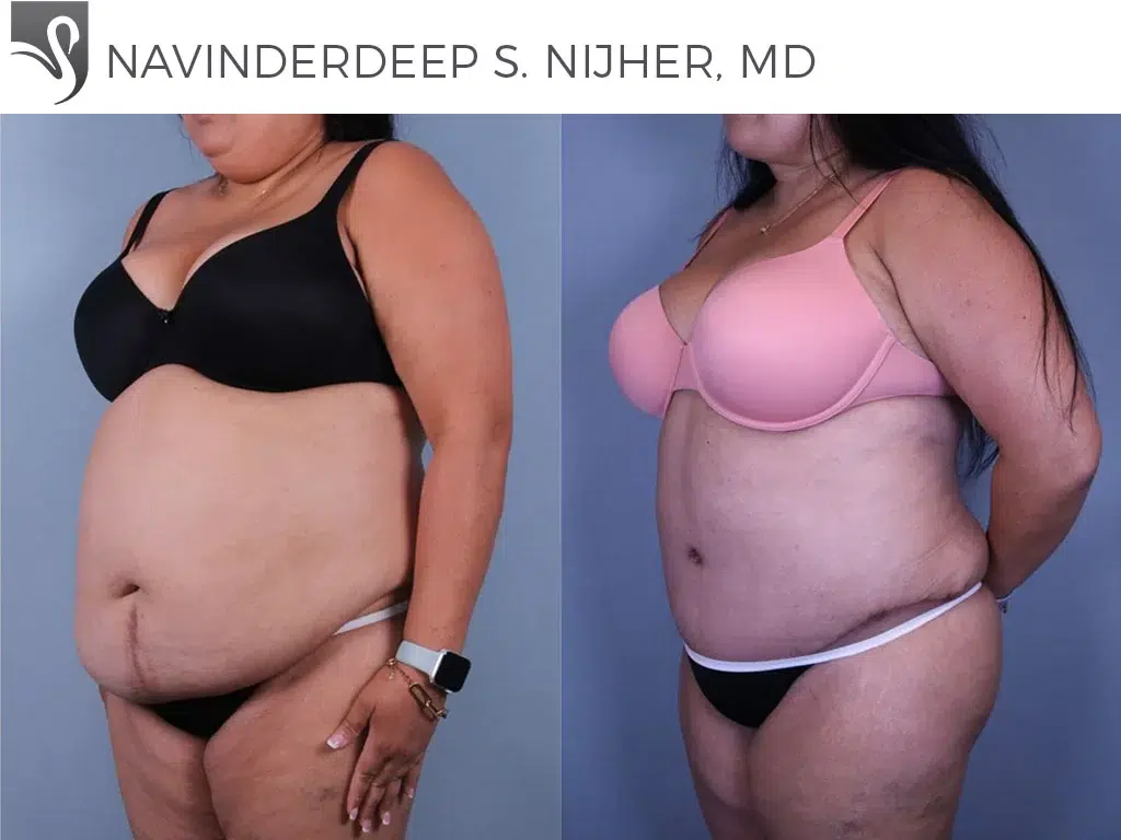 Before and After Image: Abdominoplasty (Tummy Tuck) Case #77865 - left-front-oblique