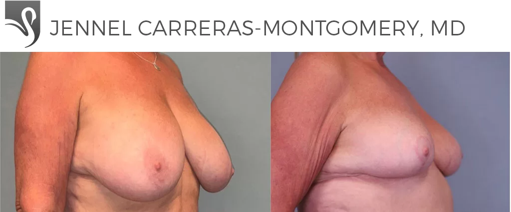 Before and After Image: Female Breast Reduction Case #77938 - right-front-oblique