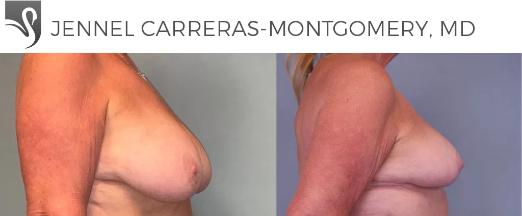 Before and After Image: Female Breast Reduction Case #77938 - right-side