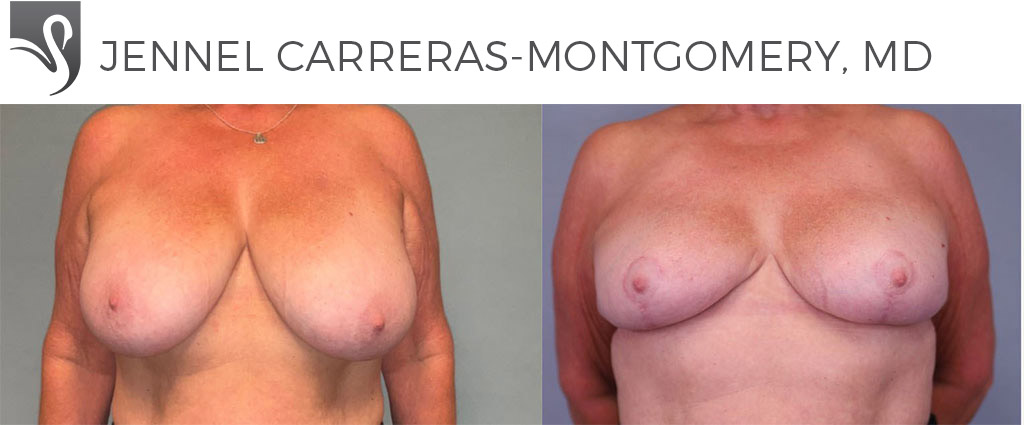 Before and After Image: Female Breast Reduction Case #77938 - front