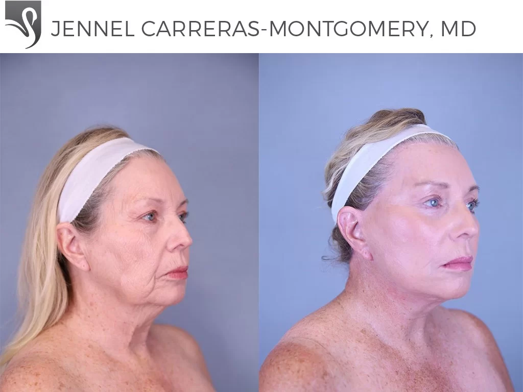 Before and After Image: Face Lift Case #78461 - right-front-oblique