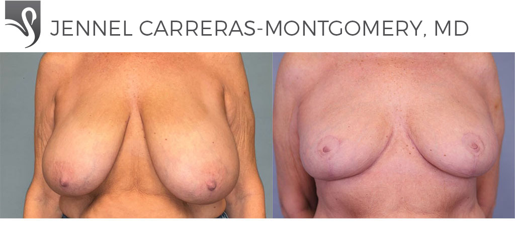 Before and After Image: Female Breast Reduction Case #78738