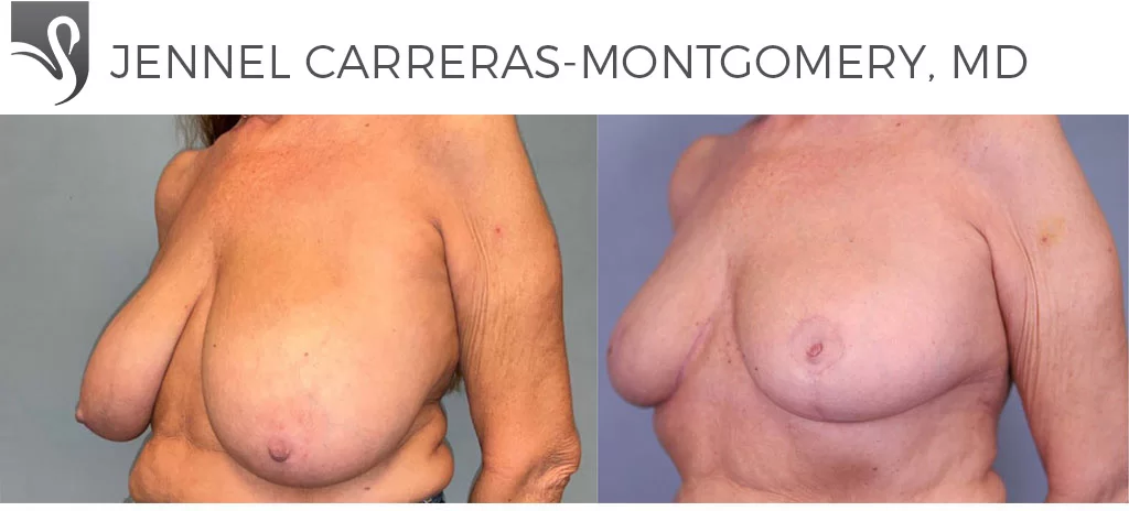 Before and After Image: Female Breast Reduction Case #78738 - left-front-oblique