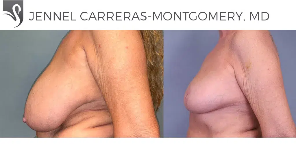 Before and After Image: Female Breast Reduction Case #78738 - left-side