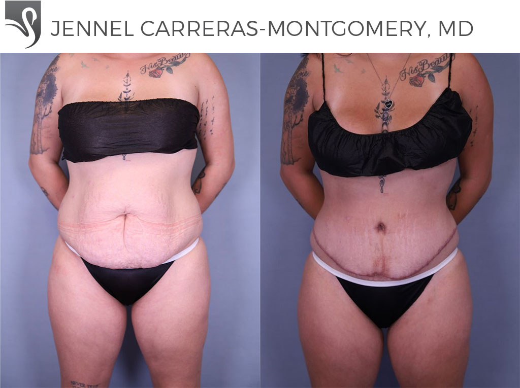 Before and After Image: Abdominoplasty (Tummy Tuck) Case #79648 - front