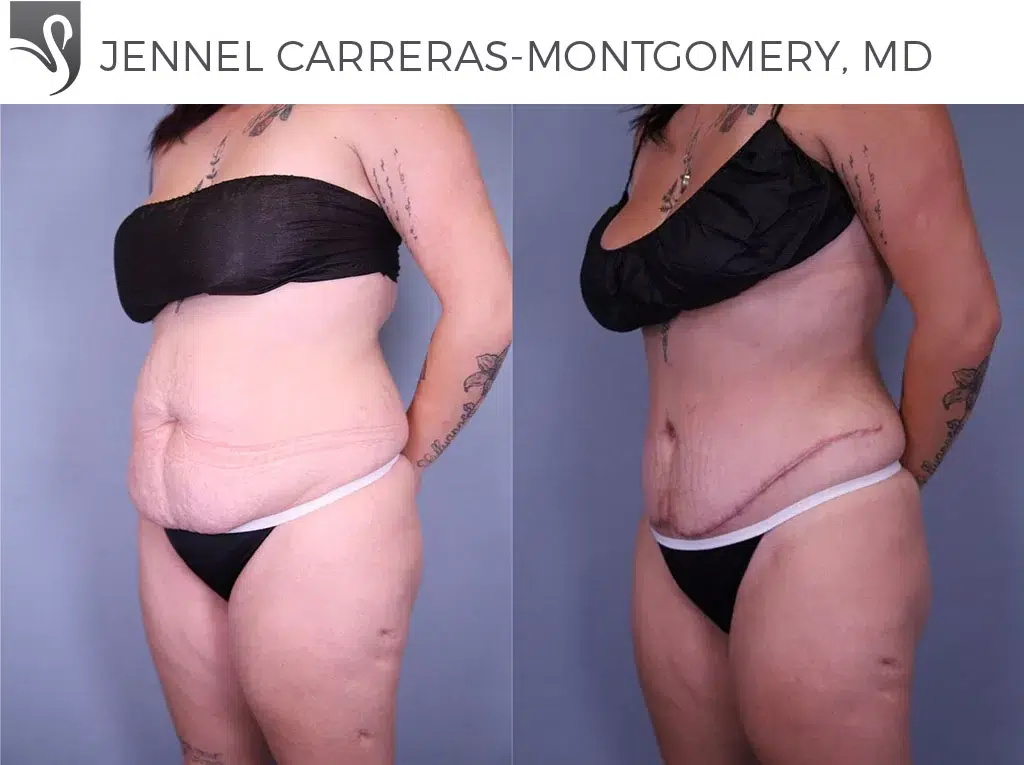 Before and After Image: Abdominoplasty (Tummy Tuck) Case #79648 - left-front-oblique