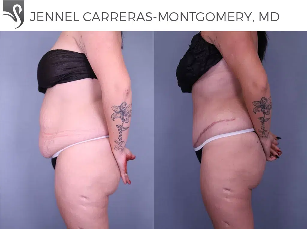 Before and After Image: Abdominoplasty (Tummy Tuck) Case #79648 - left-side