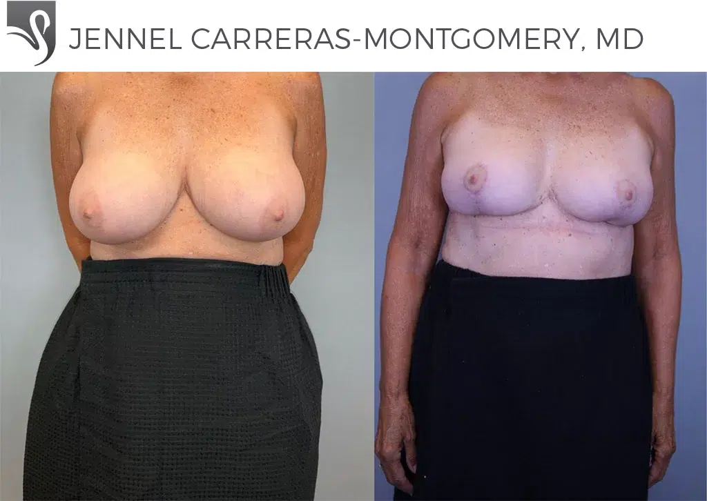 Before and After Image: Female Breast Reduction Case #79780 - front