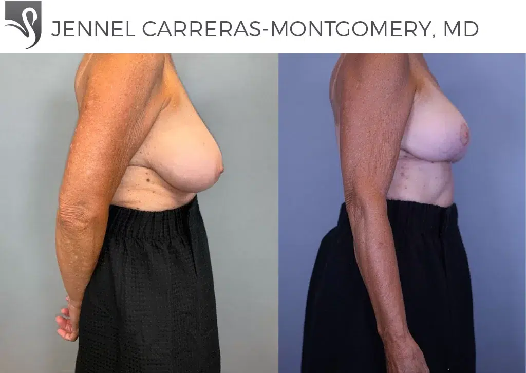 Before and After Image: Female Breast Reduction Case #79780 - right-side