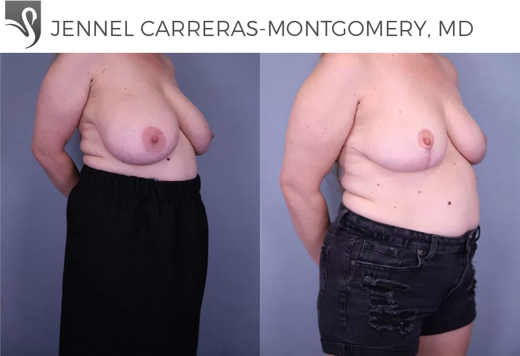 Before and After Image: Female Breast Reduction Case #79989 - right-front-oblique