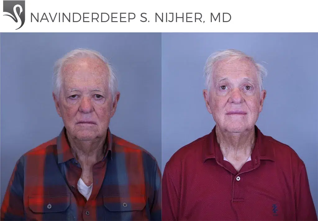 Before and After Image: Eyelid Surgery Case #80156 - front