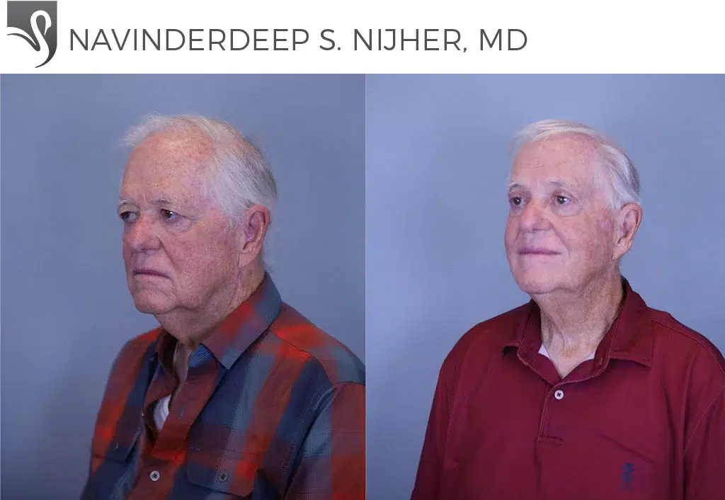 Before and After Image: Eyelid Surgery Case #80156 - left-front-oblique