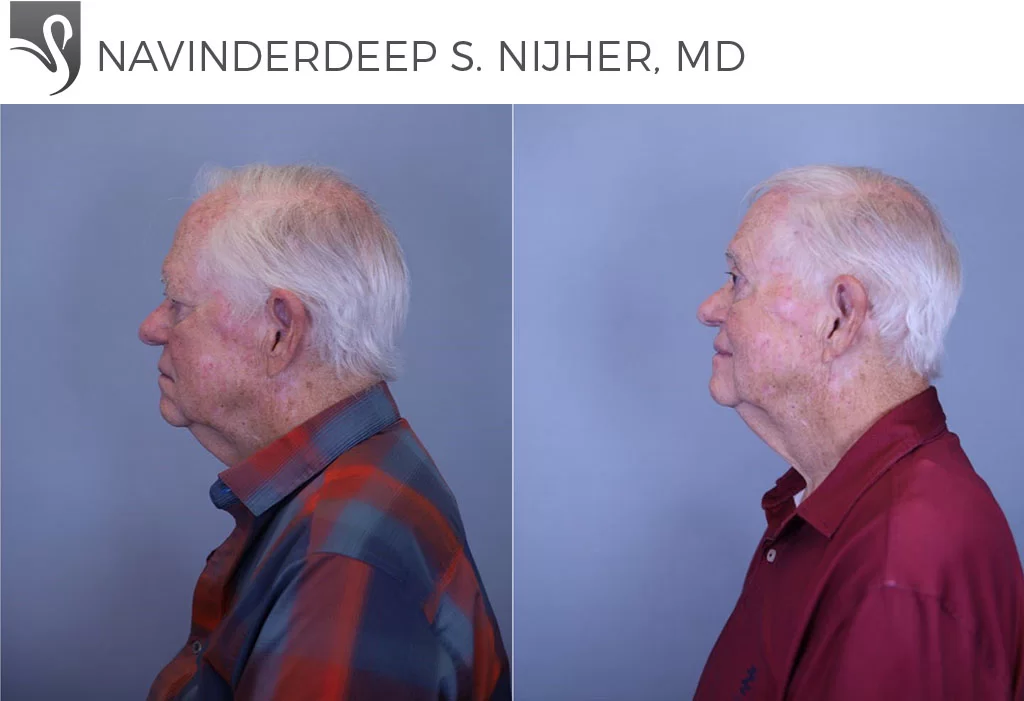 Before and After Image: Eyelid Surgery Case #80156 - left-side