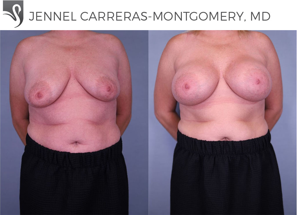 Before and After Image: Breast Augmentation Case #80278
