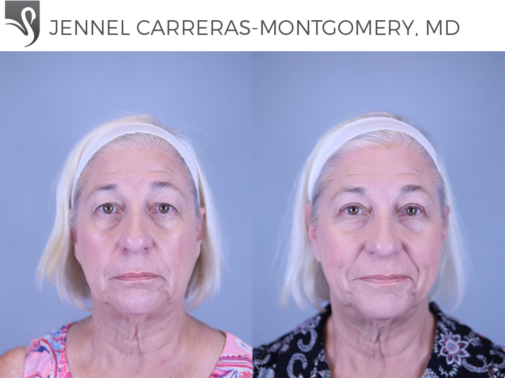 Before and After Image: Eyelid Surgery Case #81133 - front