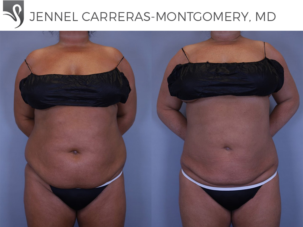 Before and After Image: Liposuction Case #81324
