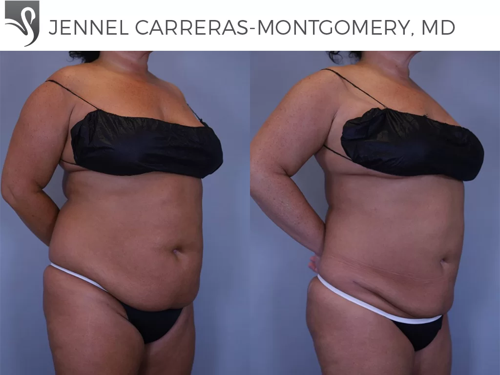 Before and After Image: Liposuction Case #81324 - right-front-oblique