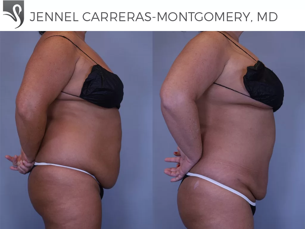 Before and After Image: Liposuction Case #81324 - right-side