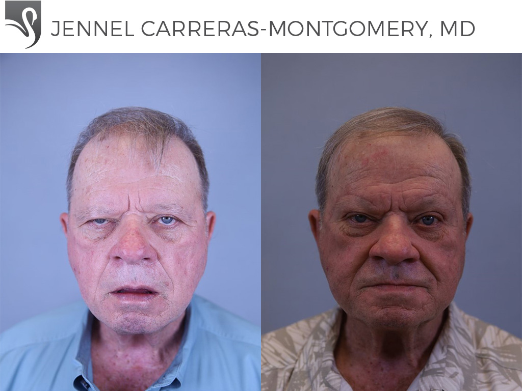 Before and After Image: Brow Lift Case #81678 - front