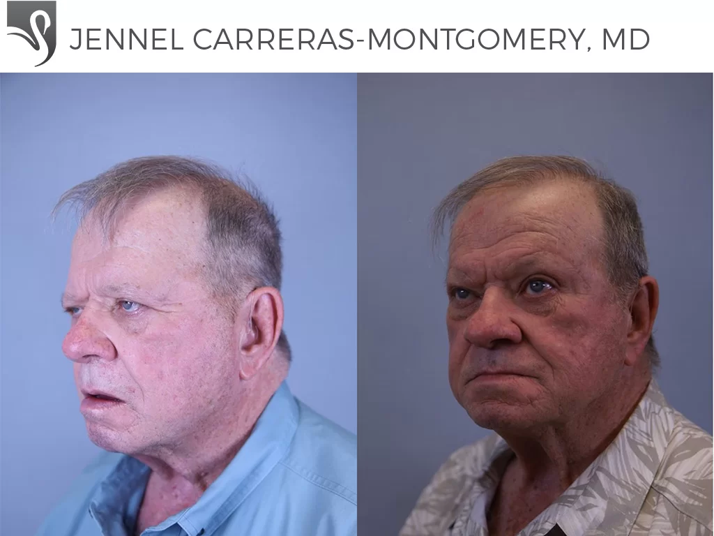 Before and After Image: Brow Lift Case #81678 - left-front-oblique