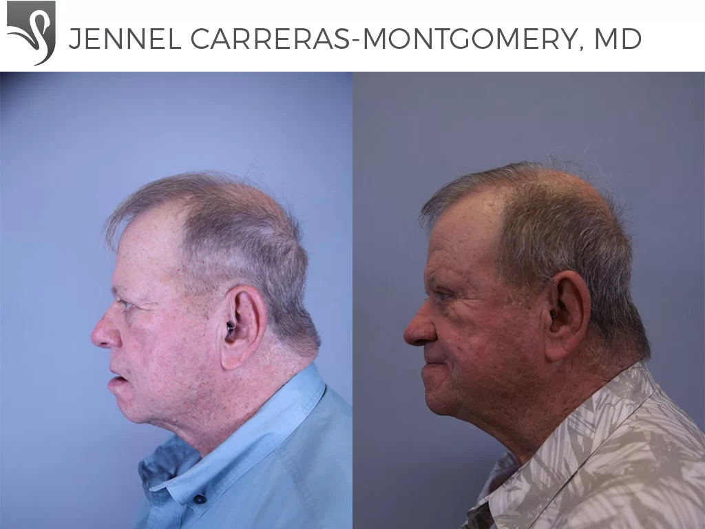 Before and After Image: Brow Lift Case #81678 - left-side