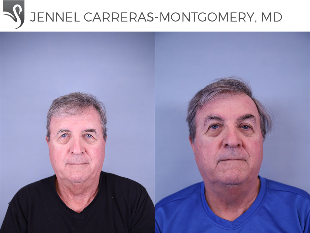 Before and After Image: Brow Lift Case #81690 - front