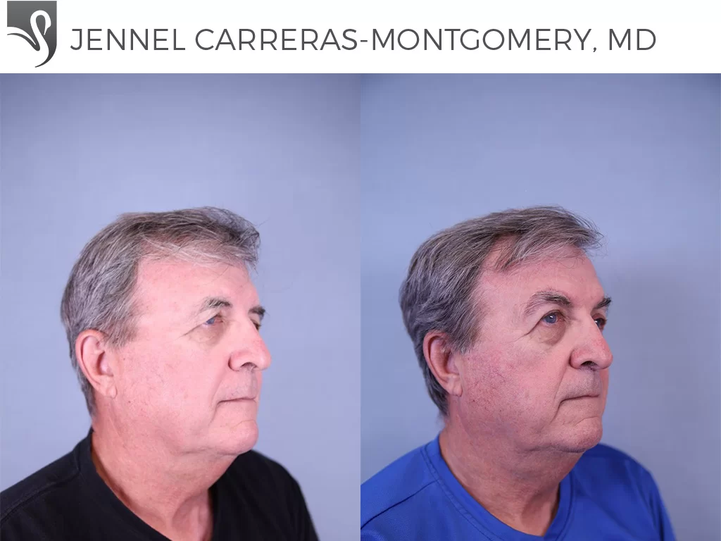 Before and After Image: Brow Lift Case #81690 - right-front-oblique