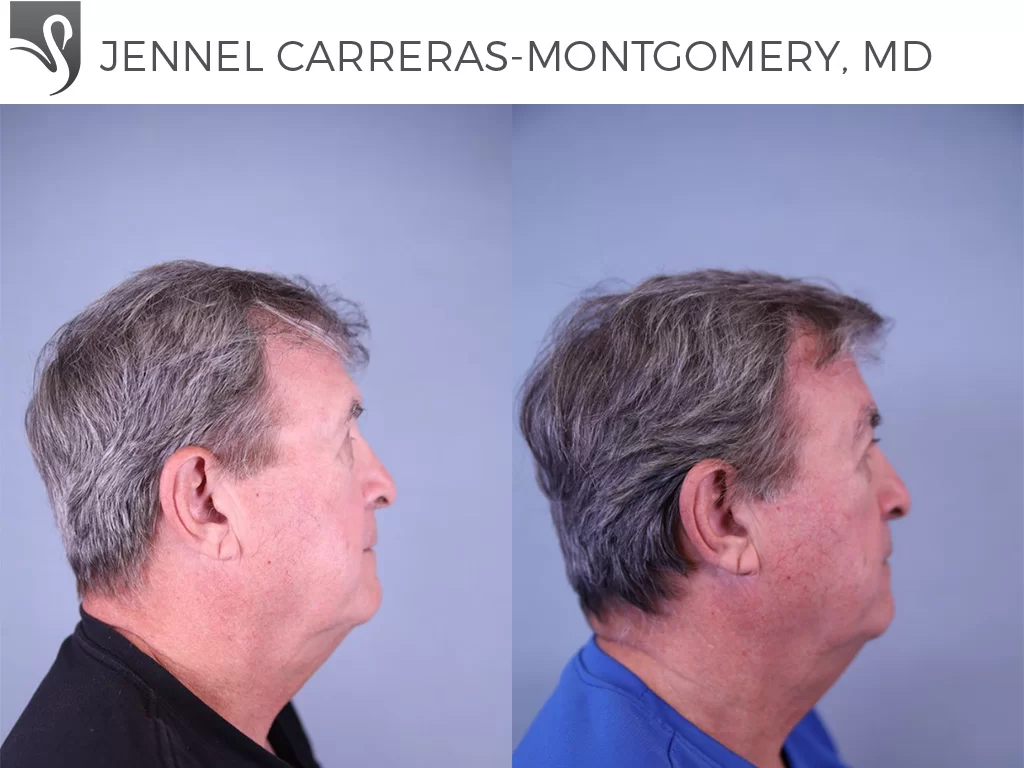 Before and After Image: Brow Lift Case #81690 - right-side